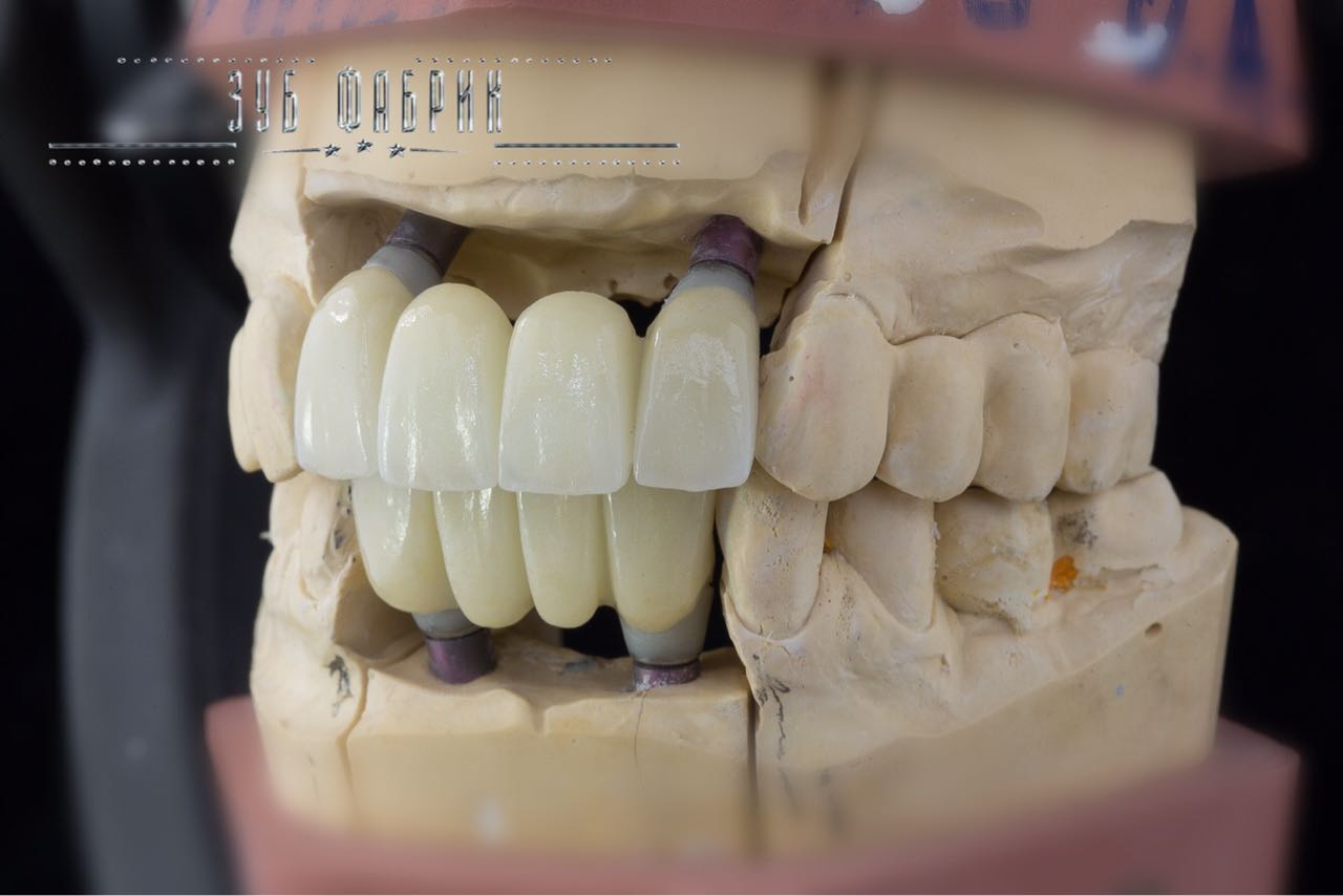 Фото протеза All on 4 протез all on 4